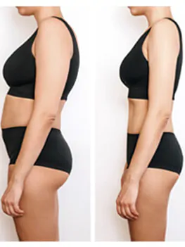 GLP-1 Therapy For Weight Loss