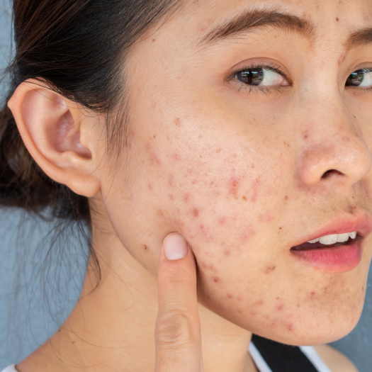 Microneedling For Acne Scars: How It Works & What To Expect