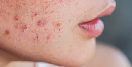 glp-1 and acne Medications Acne: Research Insights for Australia & NZ Dr. Rapaport discusses weight loss