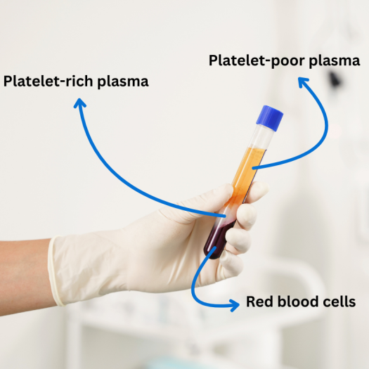 Top Benefits of PRP Hair Treatment: Is It Right for You? (Expert Recommendations)