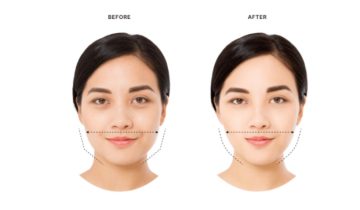 does tirzepatide affect botox and Weight Loss: How They Work Together – BotoPlace Tirzepatide (Mounjaro) In Sherman Oaks