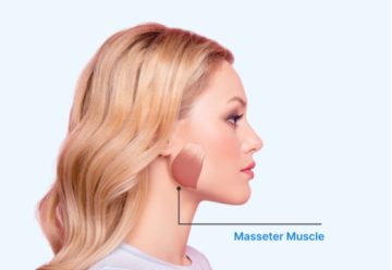 Masseter Muscle Botox