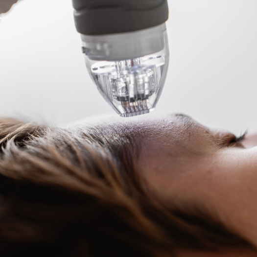 Exosome Microneedling: How It Enhances Collagen and Skin Repair