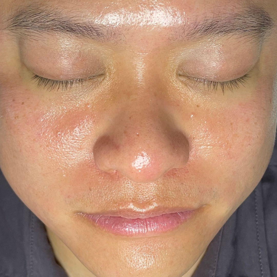 HydraFacial Los Gatos client 2 after treatment