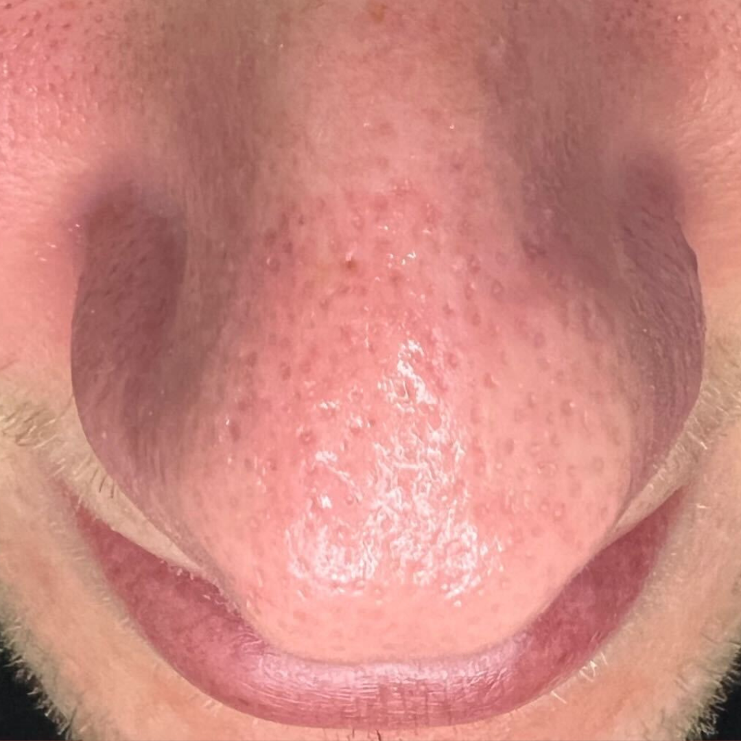 HydraFacial Los Gatos client 1 after treatment