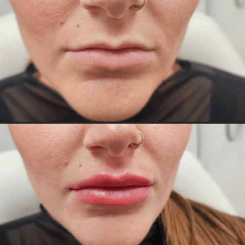 Juvéderm fillers