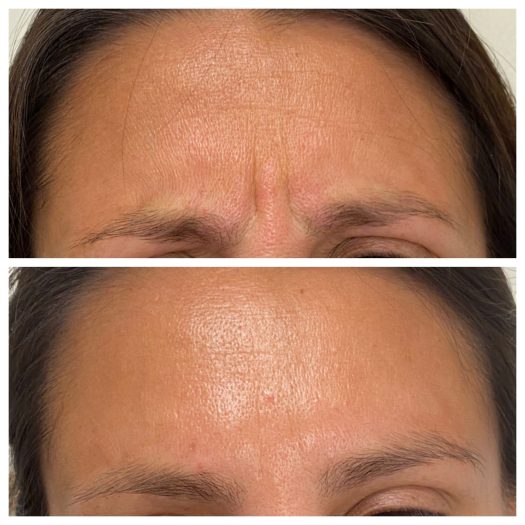 Botox in Livermore