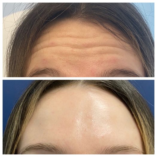 Botox in Livermore