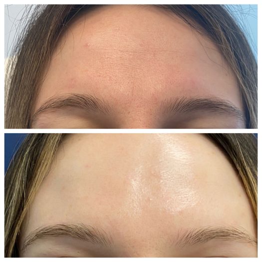 Botox in Livermore