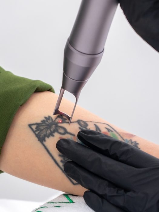 Laser Tattoo Removal in Danville