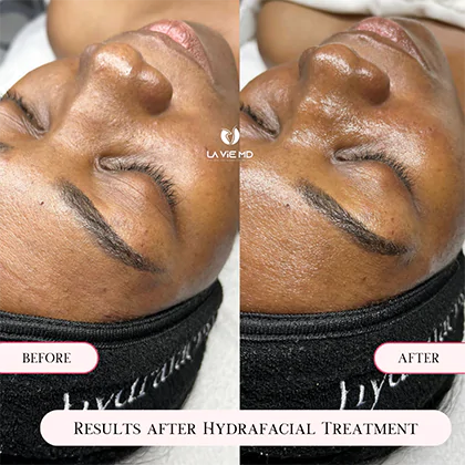 La Vie MD: Hydrafacial-Before-After-1