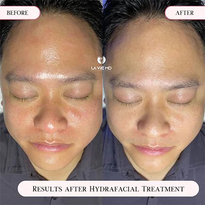La Vie MD: Hydrafacial-Before-After-3