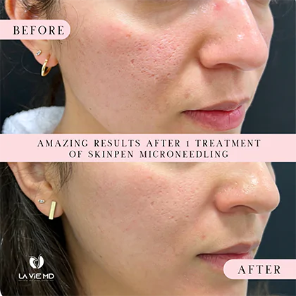 La Vie MD: Microneedling-before-after-1