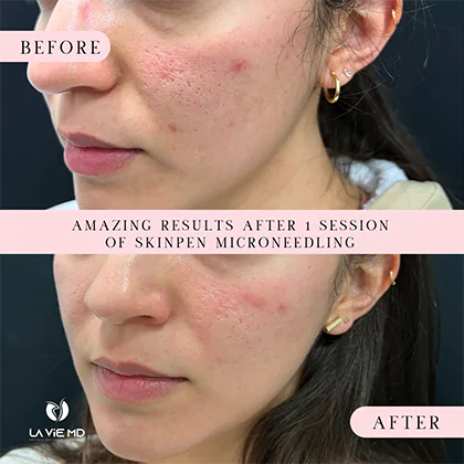 La Vie MD: Microneedling-before-after-3