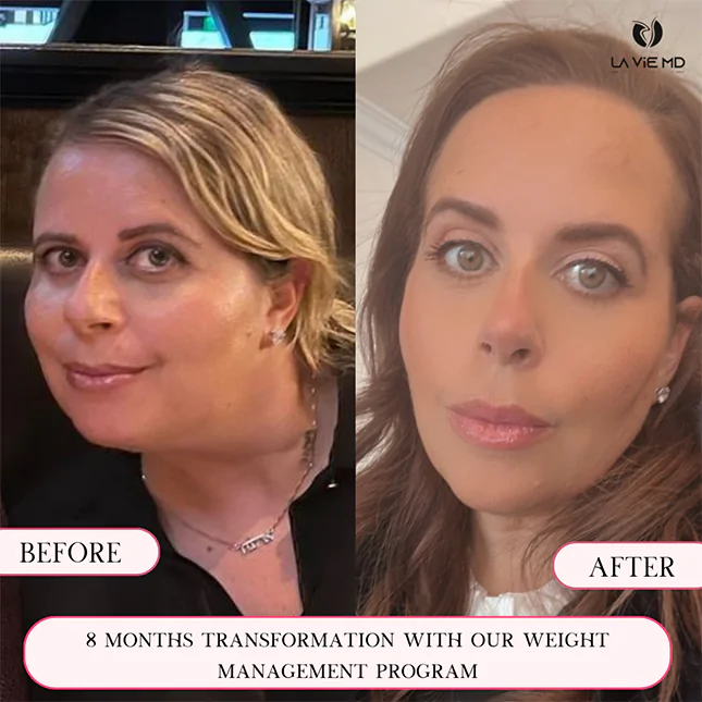 La Vie MD: semaglutide-before-after-1