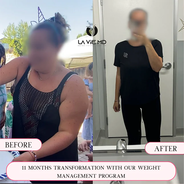 La Vie MD: semaglutide-before-after-2