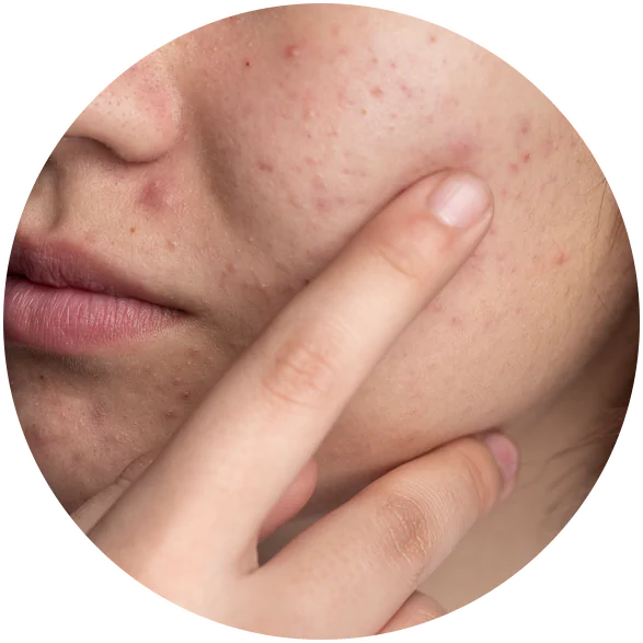 Hyperpigmentation