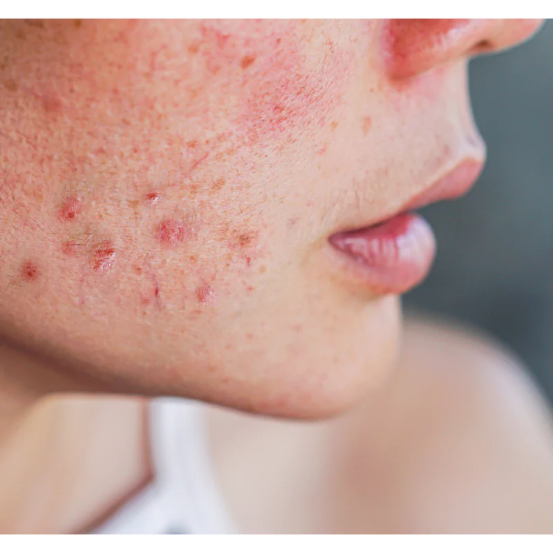 Adult Acne Treatments: Proven Strategies and Practical Tips