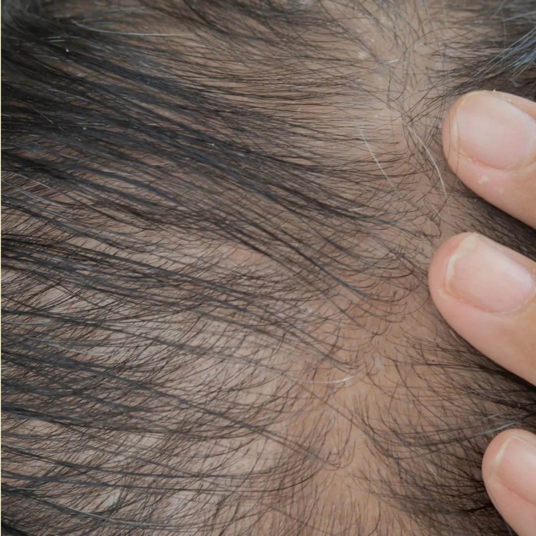 hair restoration before 2