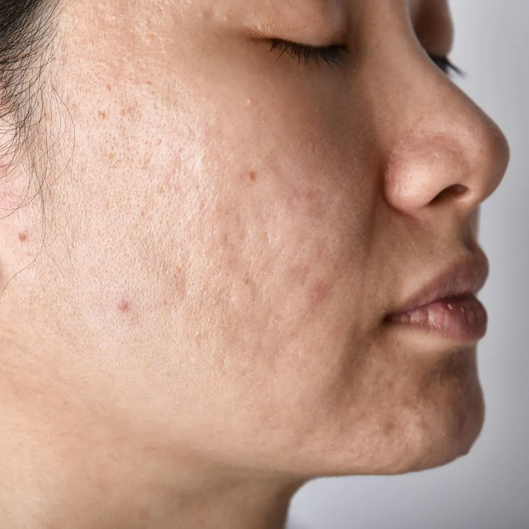 skin rejuvenation before 3