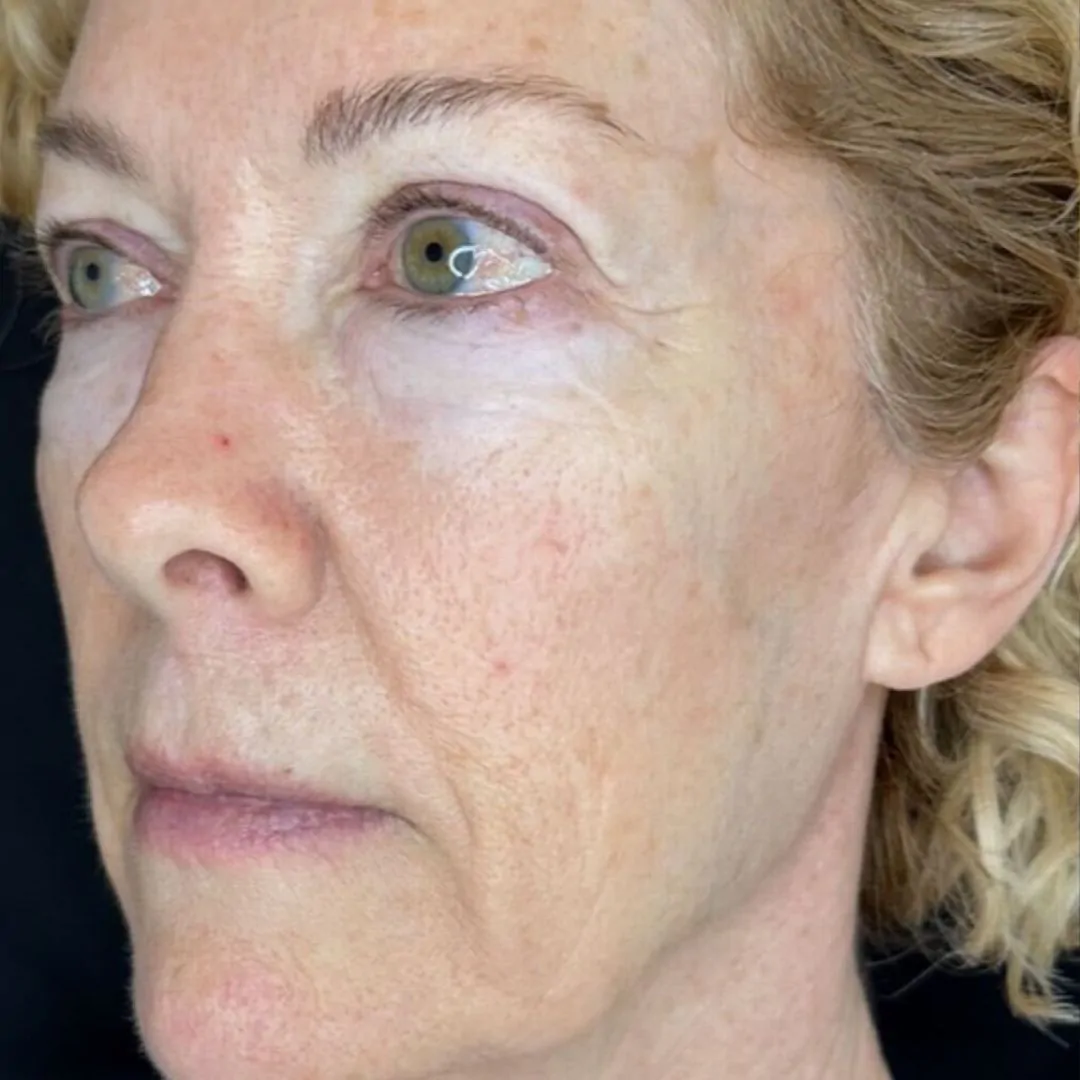 skin rejuvenation after 1