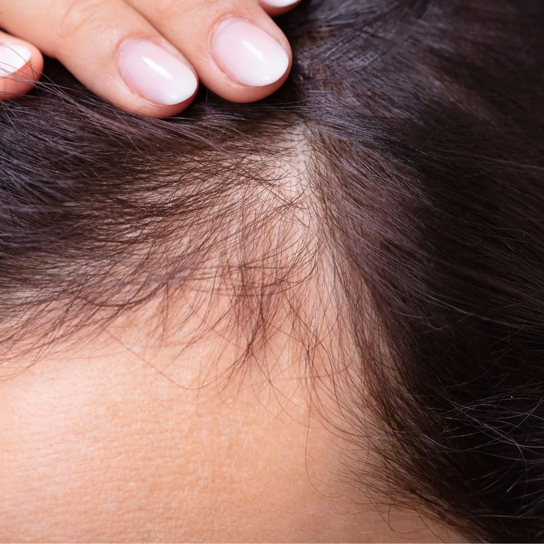 hair restoration before