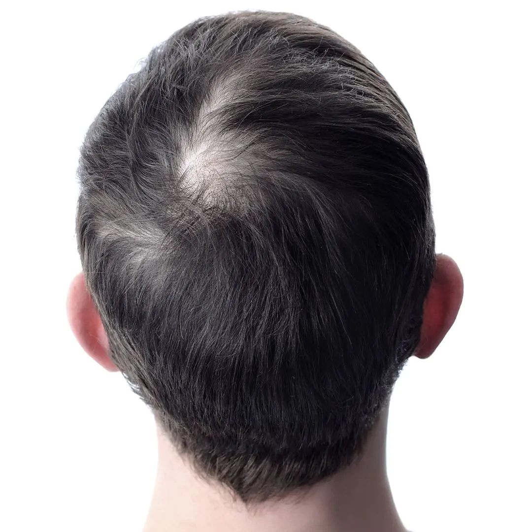 hair restoration before 1