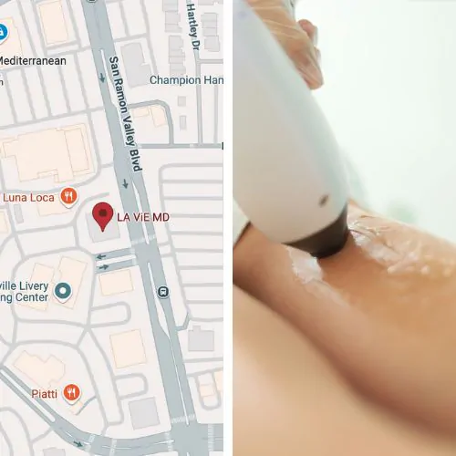 laser hair removal danville