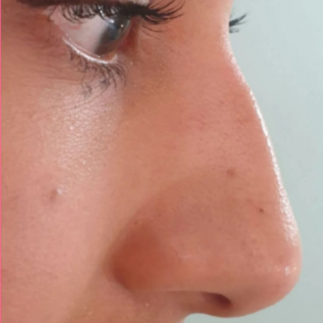 Non-Surgical Rhinoplasty