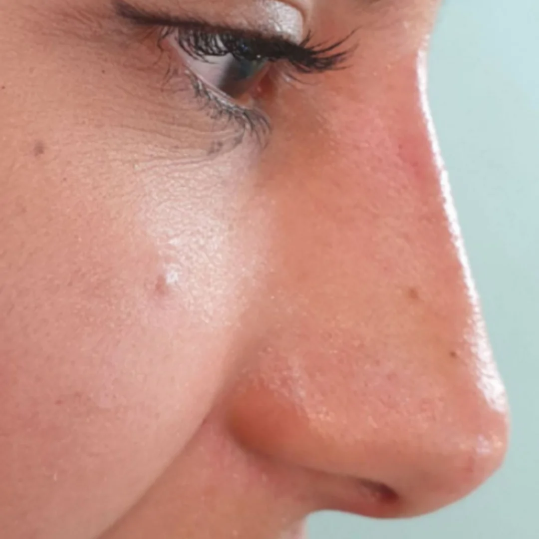 Non-Surgical Rhinoplasty