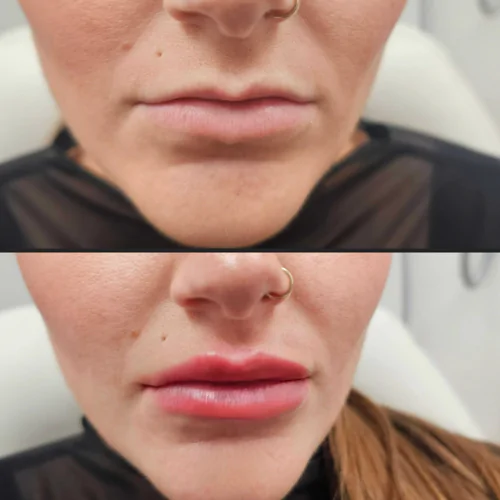 Juvéderm fillers
