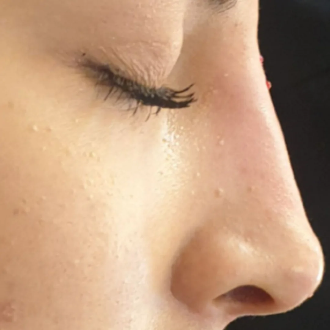 Non-Surgical Rhinoplasty