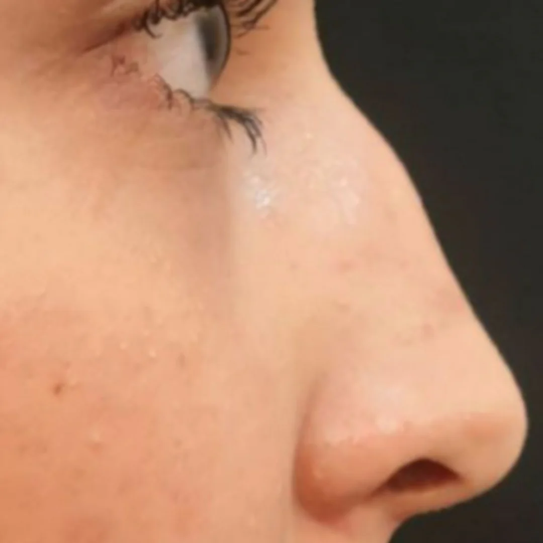 Non-Surgical Rhinoplasty