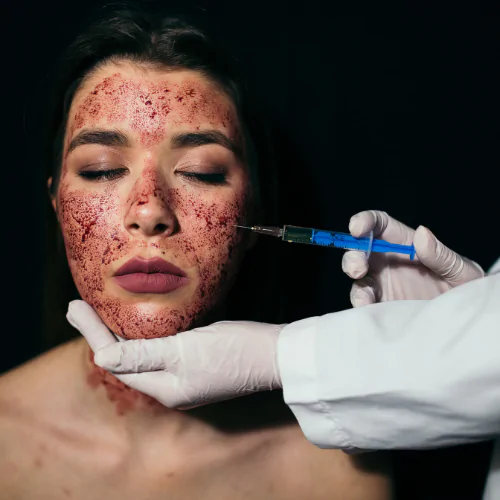 Microneedling with PRP