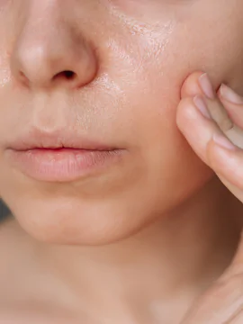 Microneedling with PRP