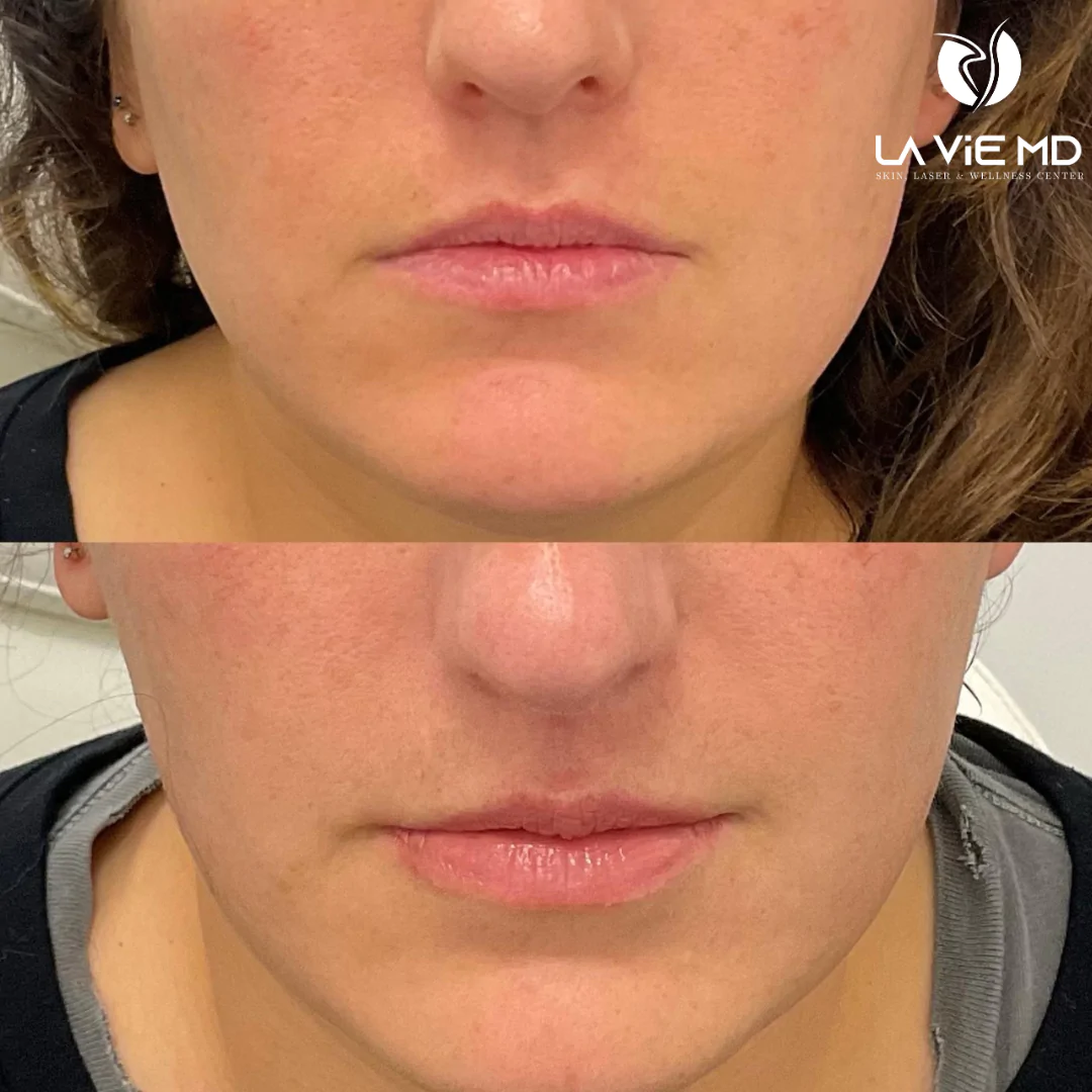 Masseter Botox Gone Wrong Jowls Risks Prevention