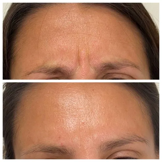 Botox in Livermore
