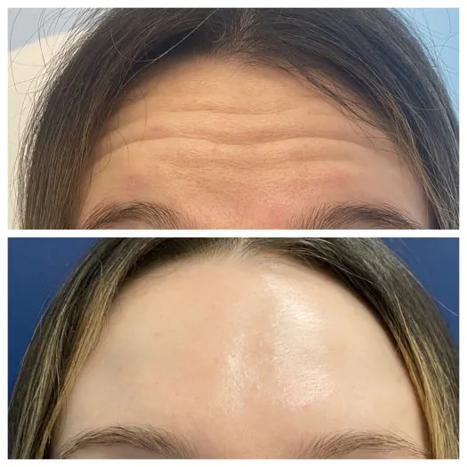 Botox in Livermore