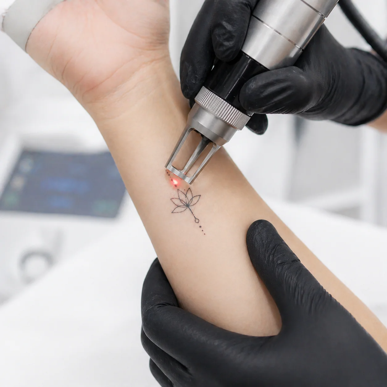 does glutathione affect tattoos Advanced Laser Tattoo Removal In Los Gatos, CA