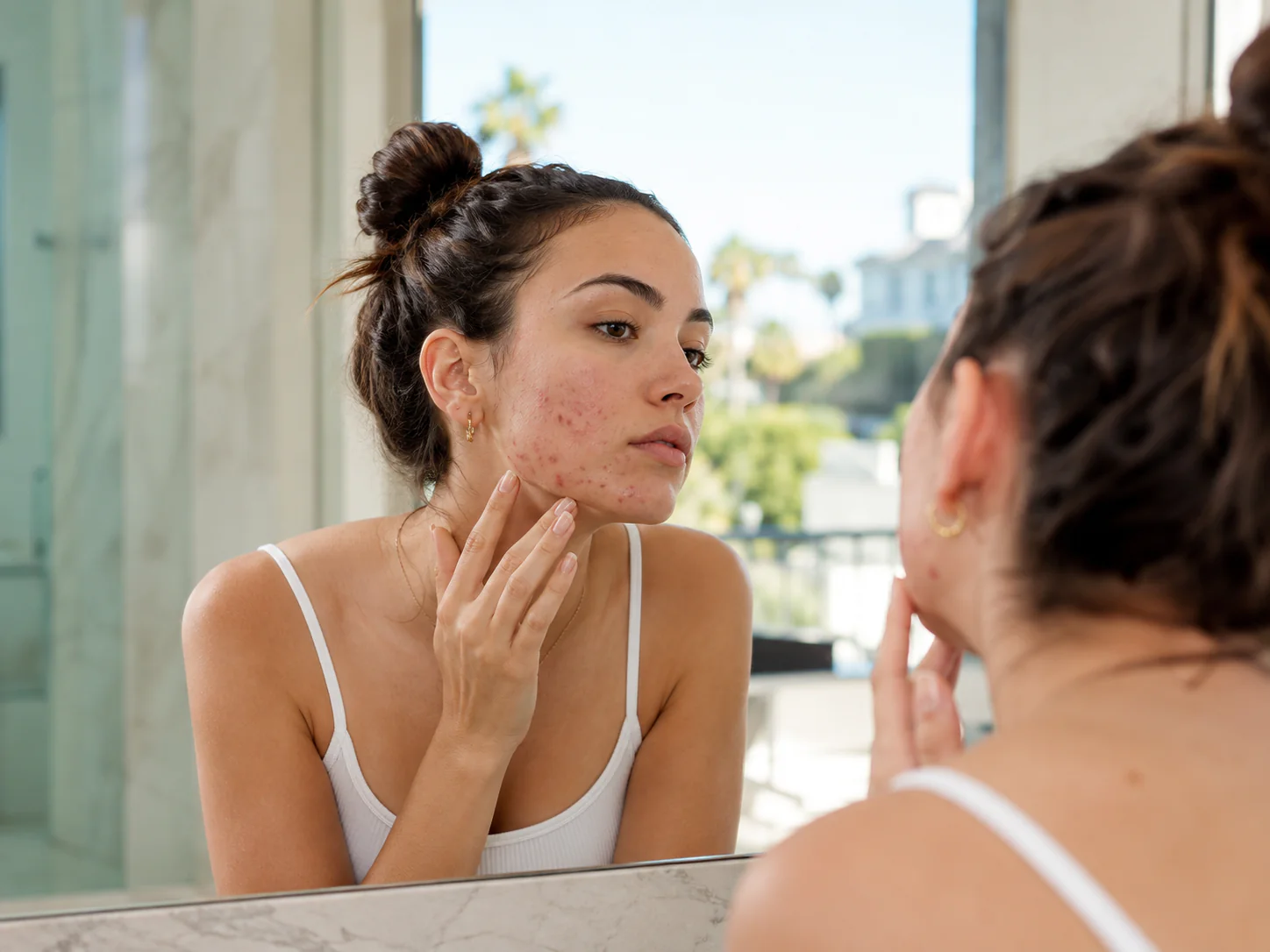 acne laser in livermore
